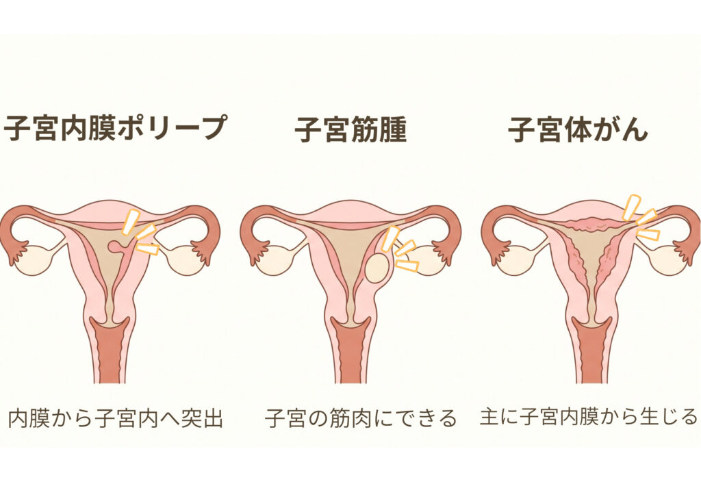 子宮内膜ポリープ、子宮筋腫、子宮体がんが生じる位置の違いを、3つの子宮断面図で比較した模式図