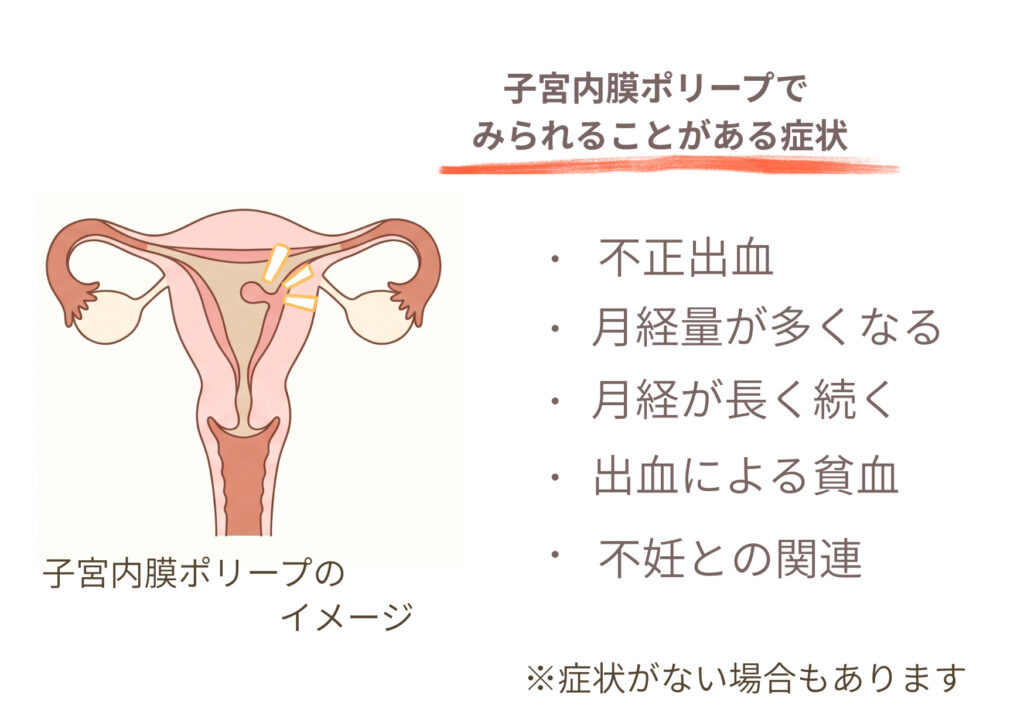 子宮内膜ポリープが子宮の内側にできるイメージと、不正出血、月経量の増加、月経の長期化、貧血、不妊との関連を示した図