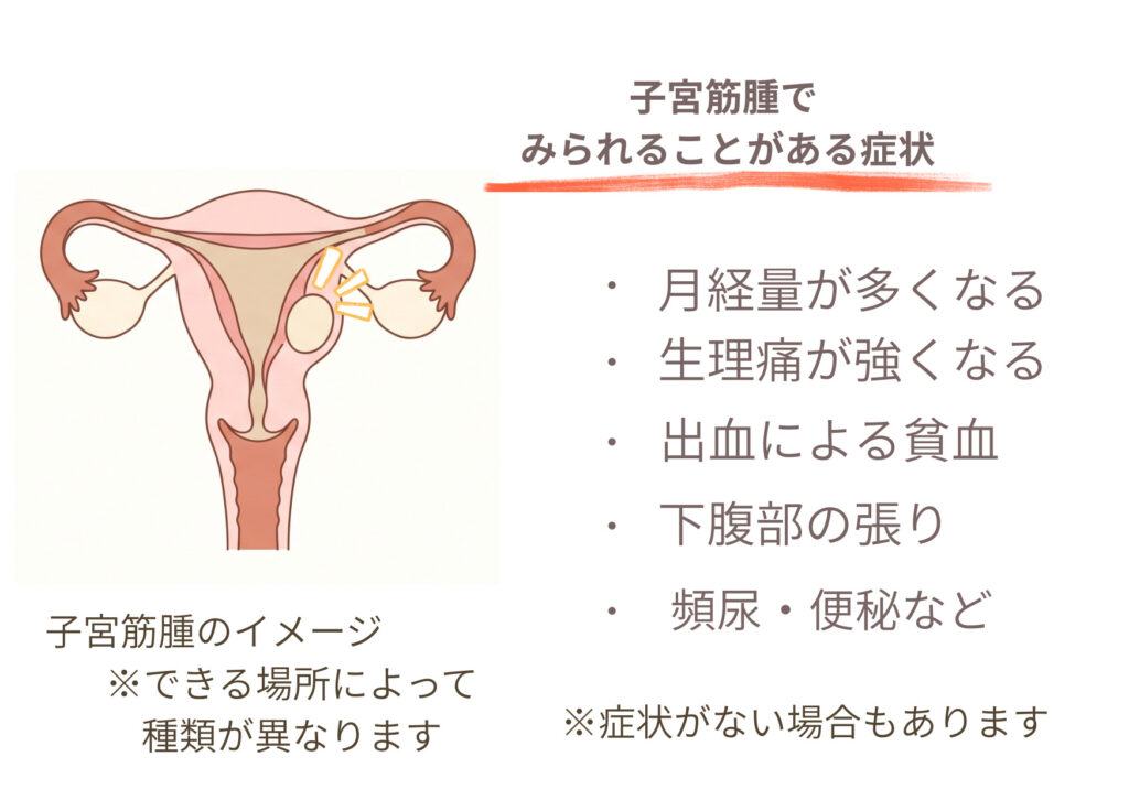 子宮の筋肉にできる子宮筋腫のイメージと、月経量の増加、生理痛、貧血、下腹部の張り、頻尿や便秘を示した図